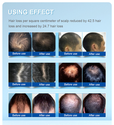 crescita dei capelli del casco del laser di trattamento di perdita di capelli di 200 diodi di luce rossa di 650nm Lllt